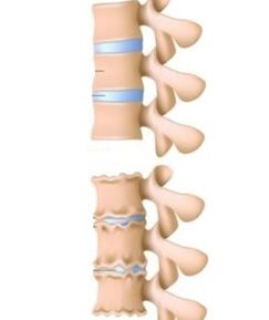 The causes of osteochondrosis