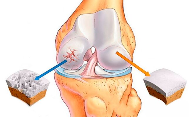 A normal knee joint (right) and one affected by arthrosis (left)