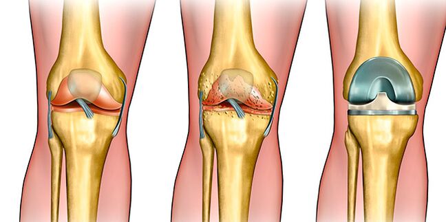 At the third stage of arthrosis, knee replacement is required