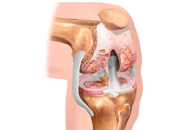 Athrosis of the knee joint