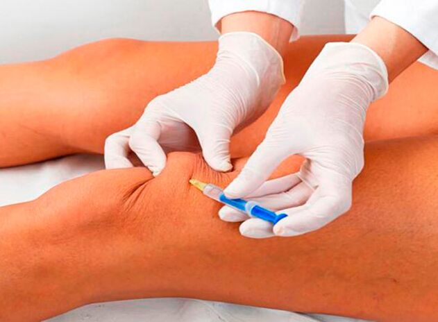 Intra-articular injections of drugs for arthrosis of the knee joint