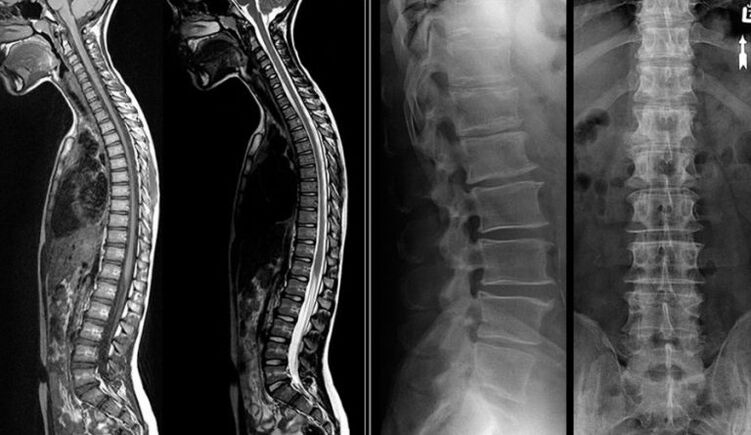 X-ray and MRI pictures for osteochondrosis