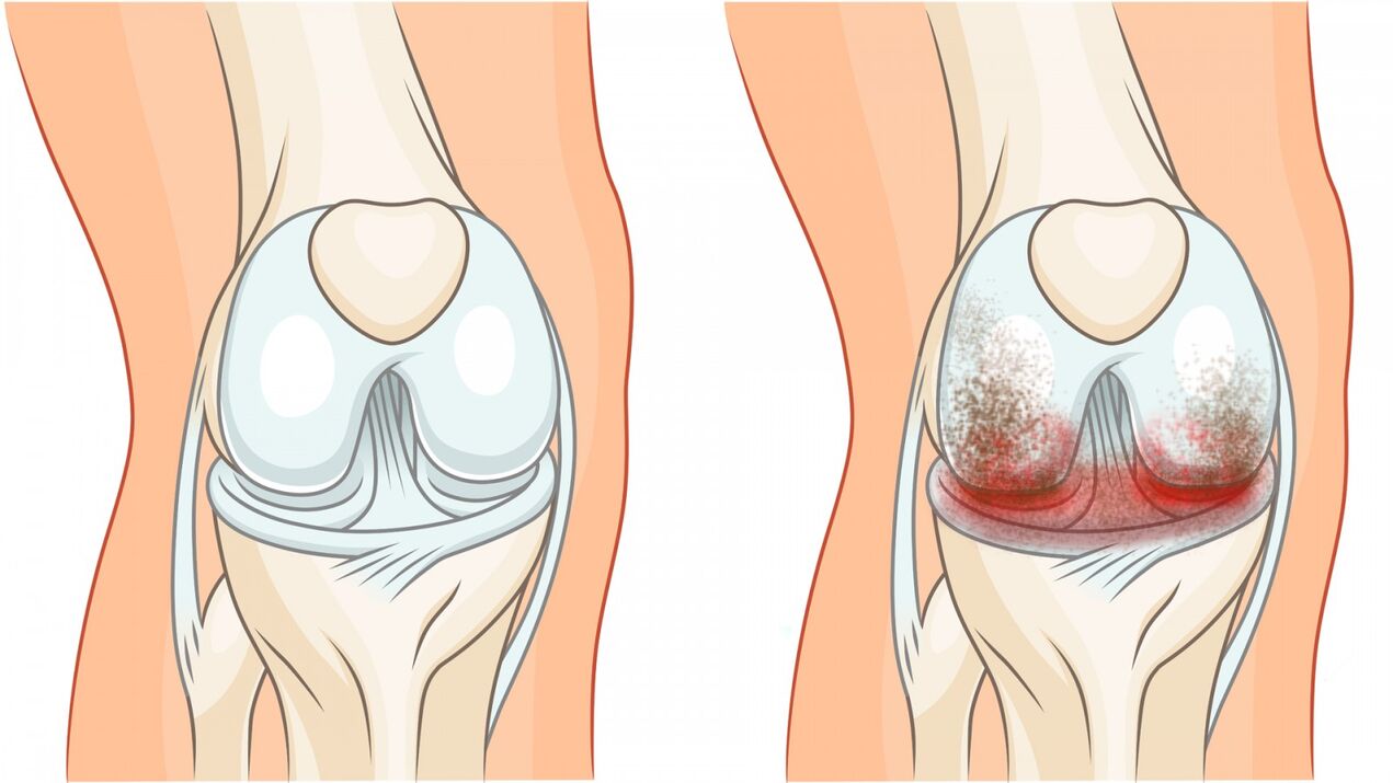 healthy joint and arthrosis of the knee joint