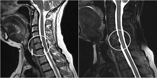 MRI of the cervical spine with signs of osteochondrosis