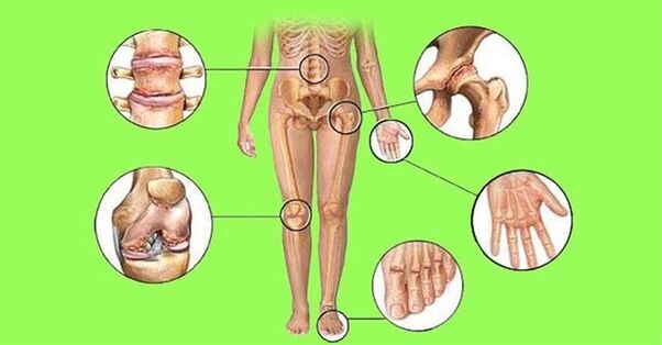 joints affected by arthritis and arthrosis