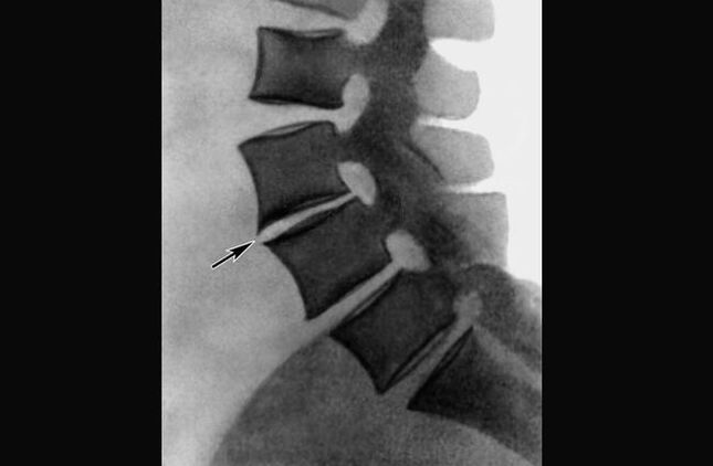 Manifestations of osteochondrosis of the thoracic spine on the radiograph