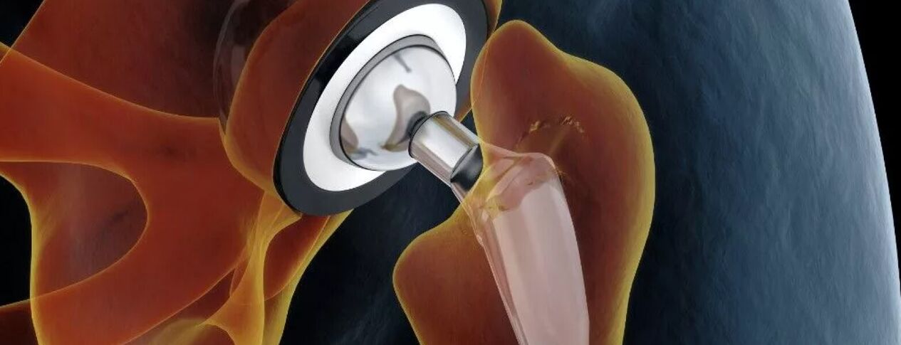 Endoprosthetics of the hip joint in coxarthrosis of the last degree