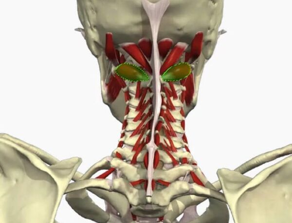 Vail artery syndrome